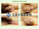 生殖整形延长术后的图片